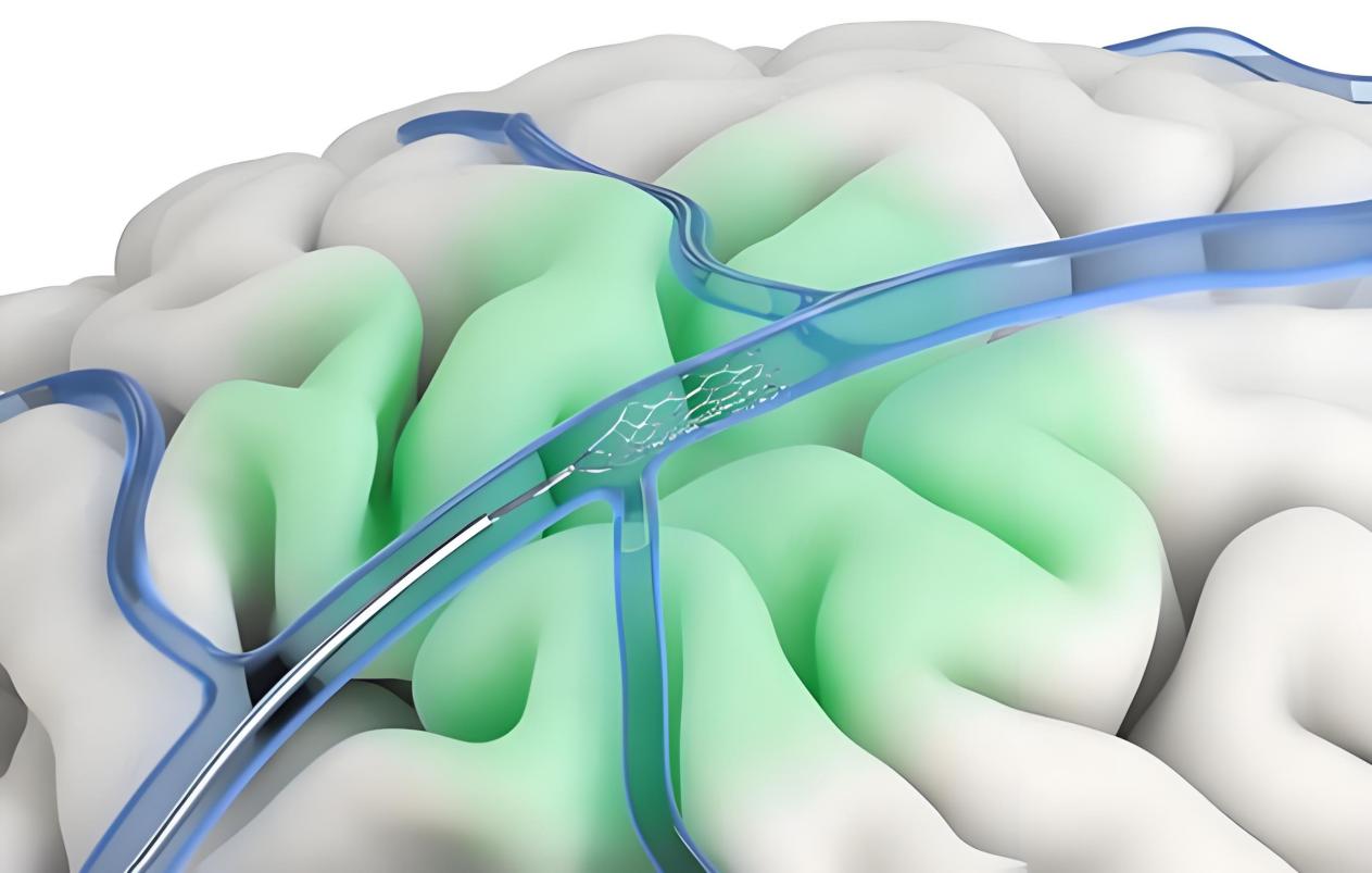 陈根：把脑机接口“打进血管”，意味着什么？